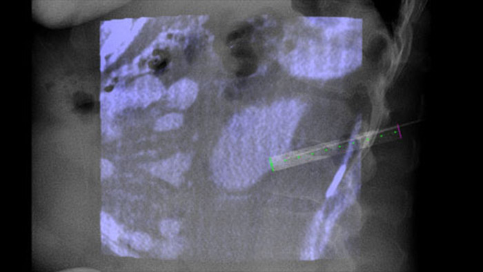 Live-Nadelverlaufsf&uuml;hrung mit XperGuide