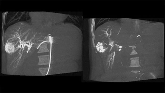 3D-Bildgebung nach der Embolisation mit CBCT