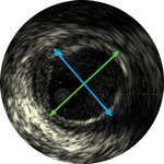 Gef&auml;&szlig;durchmesser image