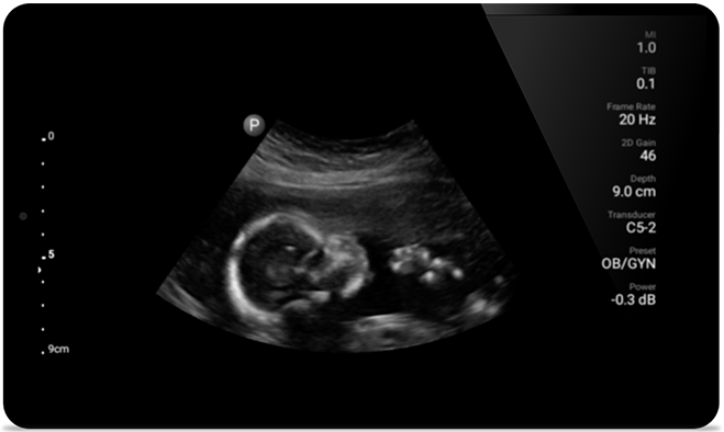 ein Ultraschall eines Babys