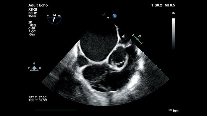 Diagnostische transthorakale und trans&ouml;sophageale 2D- und 3D-Schallk&ouml;pfe
