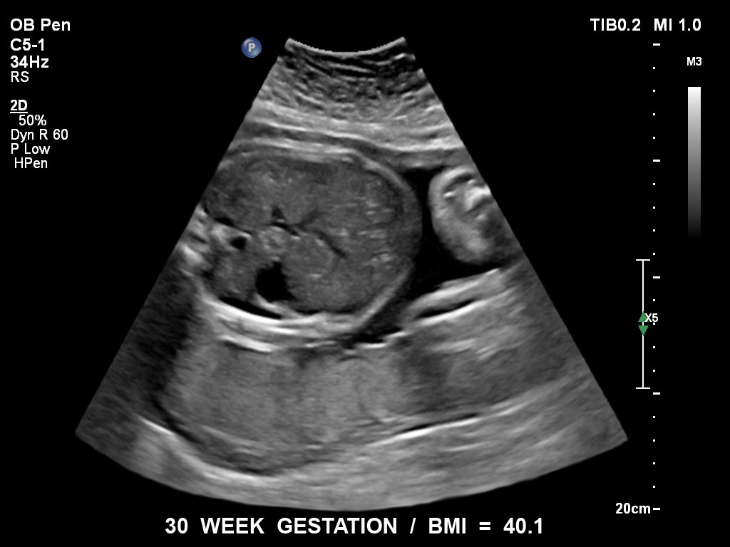 Ultraschallbild Gyn&auml;kologie Beispiel 10