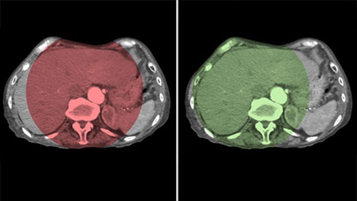 Vollst&auml;ndige Abdeckung der Leber mit CBCT Open